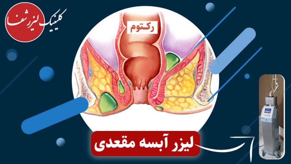 لیزر آبسه مقعدی