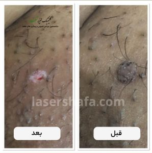 تصویر قبل و بعد زگیل تناسلی 