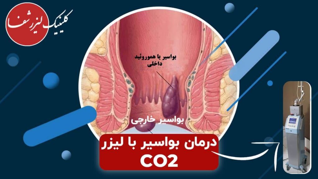 درمان هموروئید با لیزر