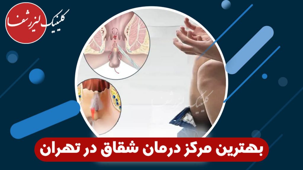 بهترین مرکز برای درمان شقاق در تهران