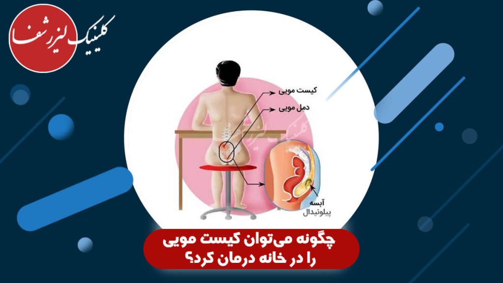 چگونه می‌توان کیست مویی را در خانه درمان کرد؟