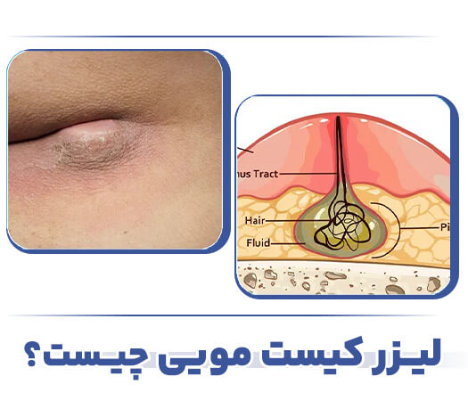کیست مویی چیست؟