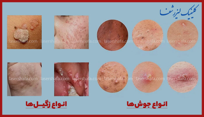 عکس زگیل تناسلی و عکس جوش تناسلی