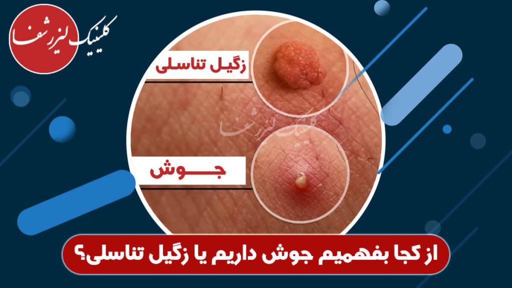 از کجا بفهمیم جوش داریم یا زگیل تناسلی؟ تفاوت‌ها و روش‌های تشخیص دقیق