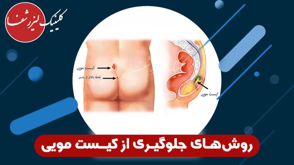 تصویر روش‌های جلوگیری از کیست مویی