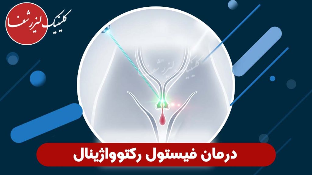 درمان فیستول رکتوواژینال
