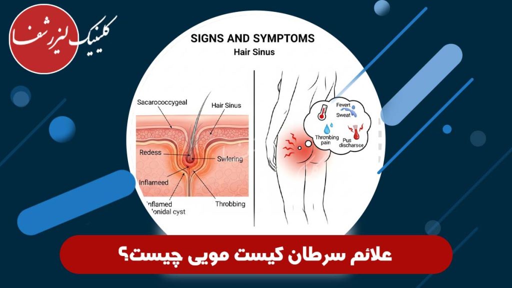 علائم سرطان کیست مویی چیست