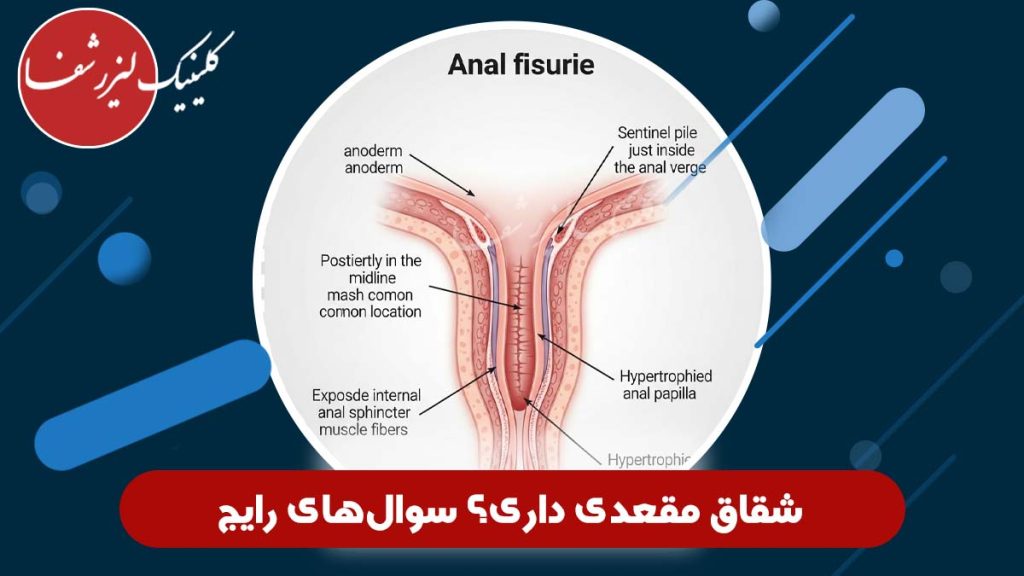 شقاق مقعدی