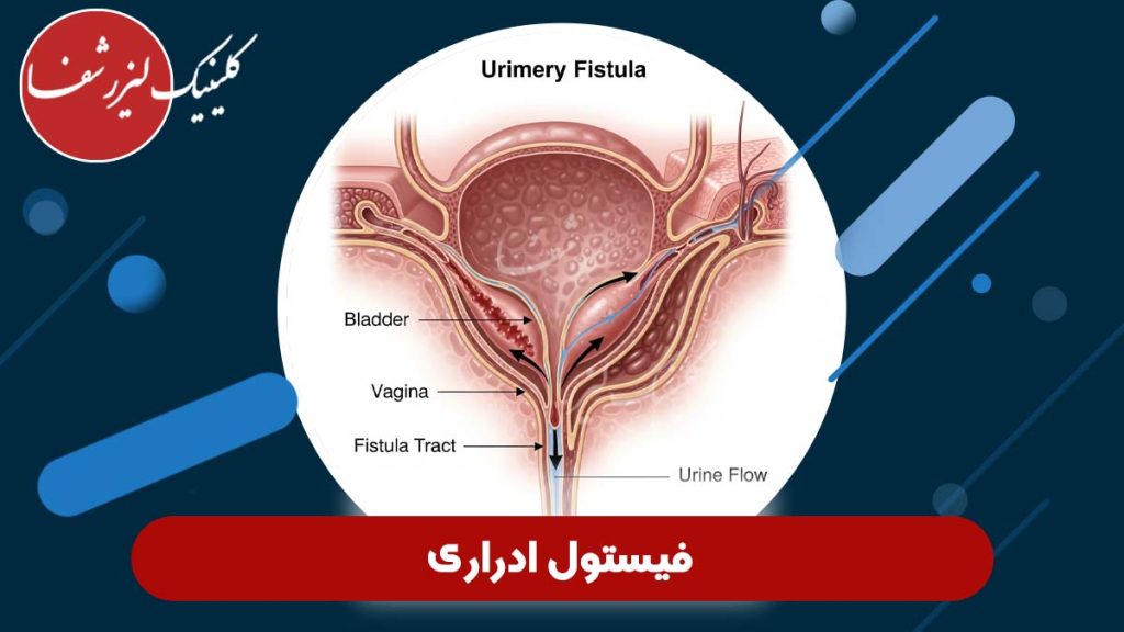 فیستول ادراری چیست؟