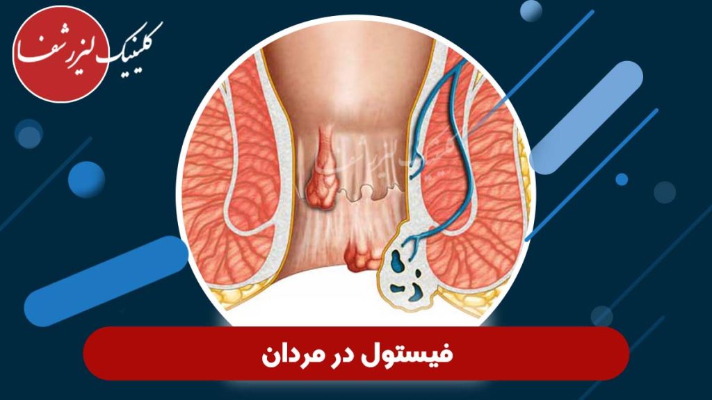 فیستول در مردان