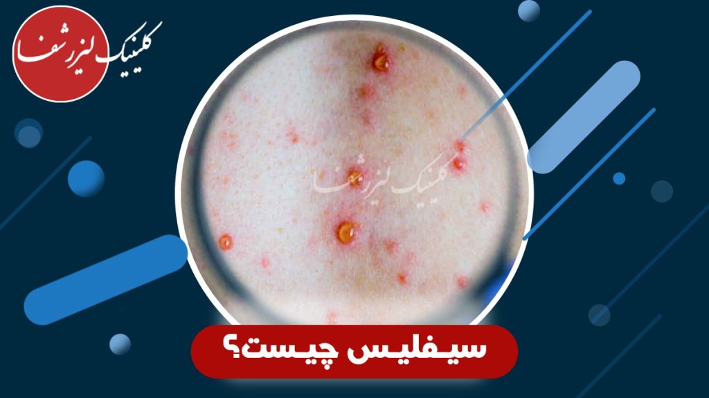 سیفلیس چیست