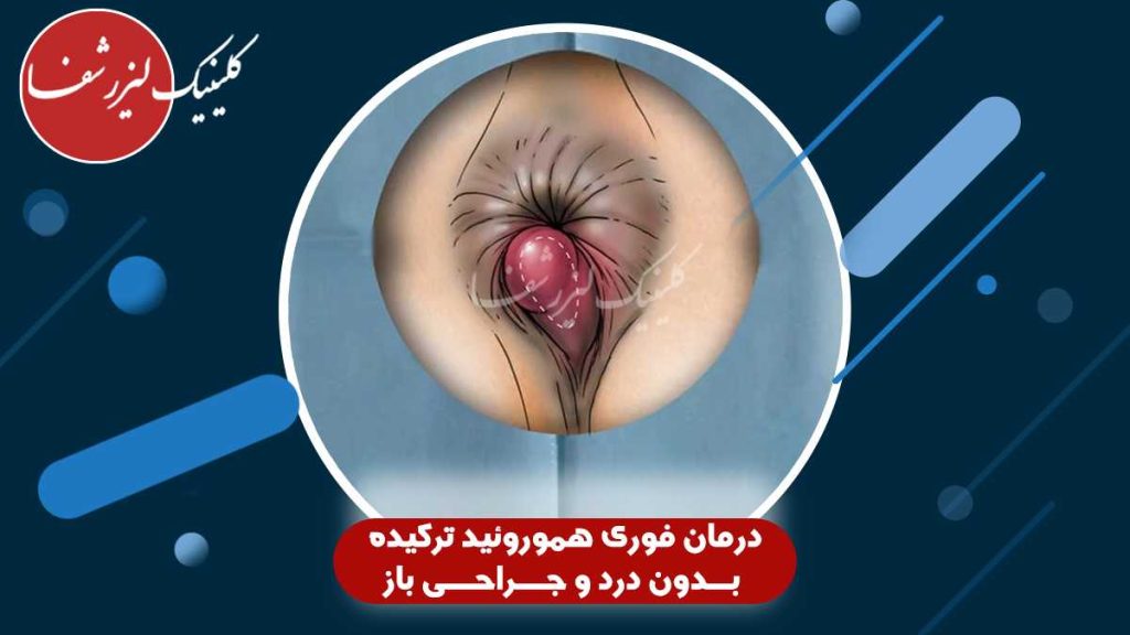 تصویر هموروئید بیرونی ترکیده با التهاب و خونریزی در ناحیه مقعد – نمونه واقعی قبل از درمان لیزری