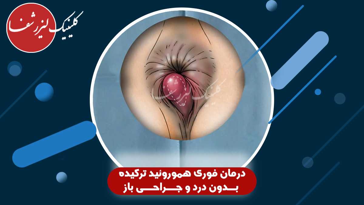 تصویر هموروئید بیرونی ترکیده با التهاب و خونریزی در ناحیه مقعد – نمونه واقعی قبل از درمان لیزری