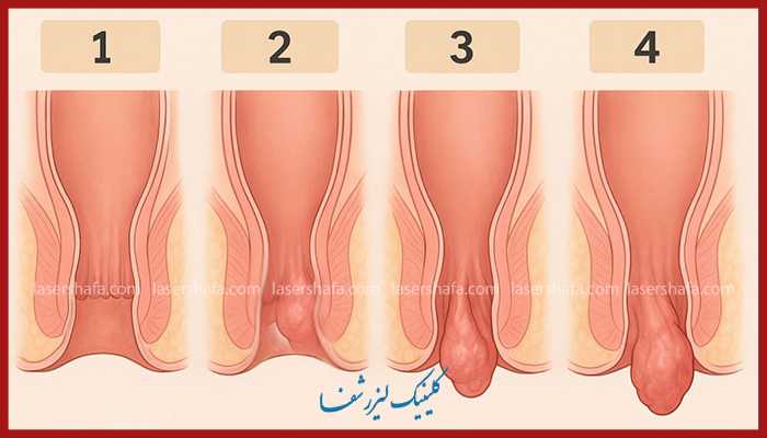 تصویر مراحل مختلف هموروئید داخلی از درجه ۱ تا ۴ – بروز علائم و شدت بیماری بواسیر