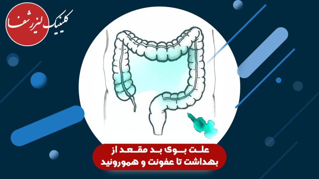 علت بوی بد مقعد می‌تواند ناشی از عفونت، هموروئید، آبسه یا رعایت نکردن بهداشت باشد.