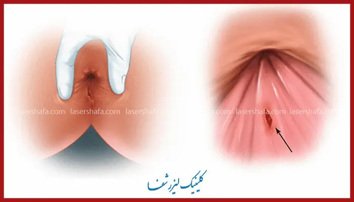 عمل جراحی شقاق مقعدی با لیزر