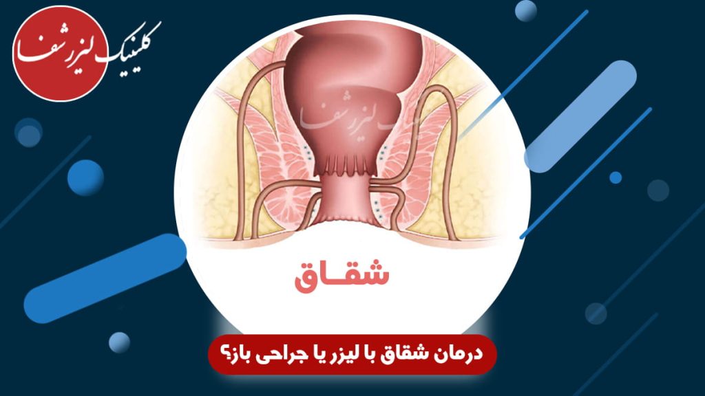 درمان شقاق با لیزر یا جراحی باز