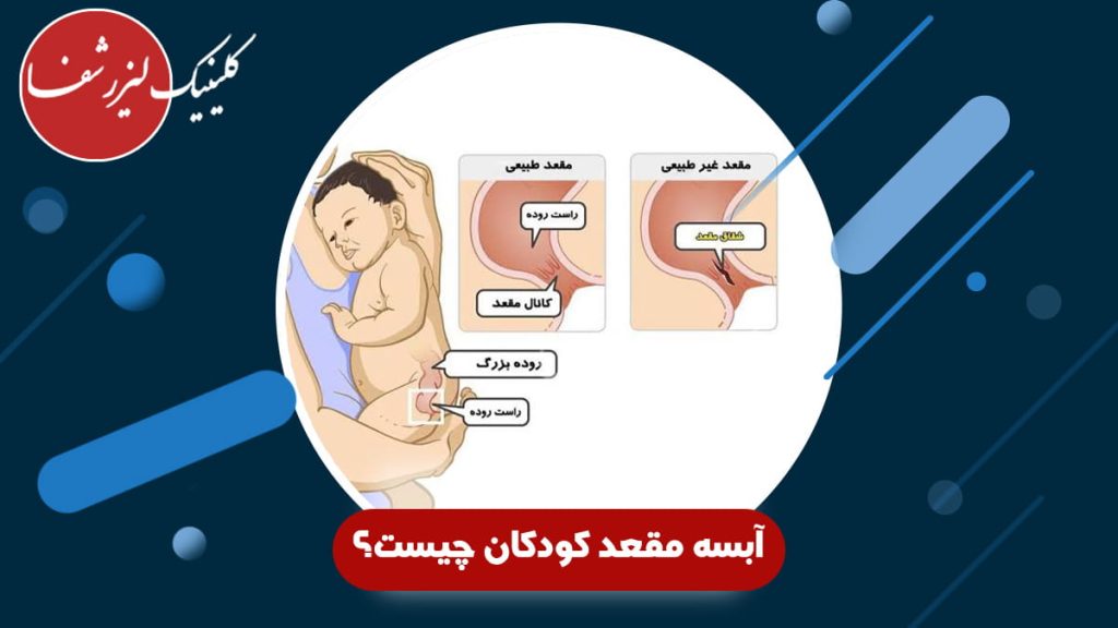 مقایسه مقعد طبیعی و غیرطبیعی (شقاق و آبسه) در نوزاد، مقاله آموزشی آبسه مقعد کودکان چیست در کلینیک لیزر شفا.