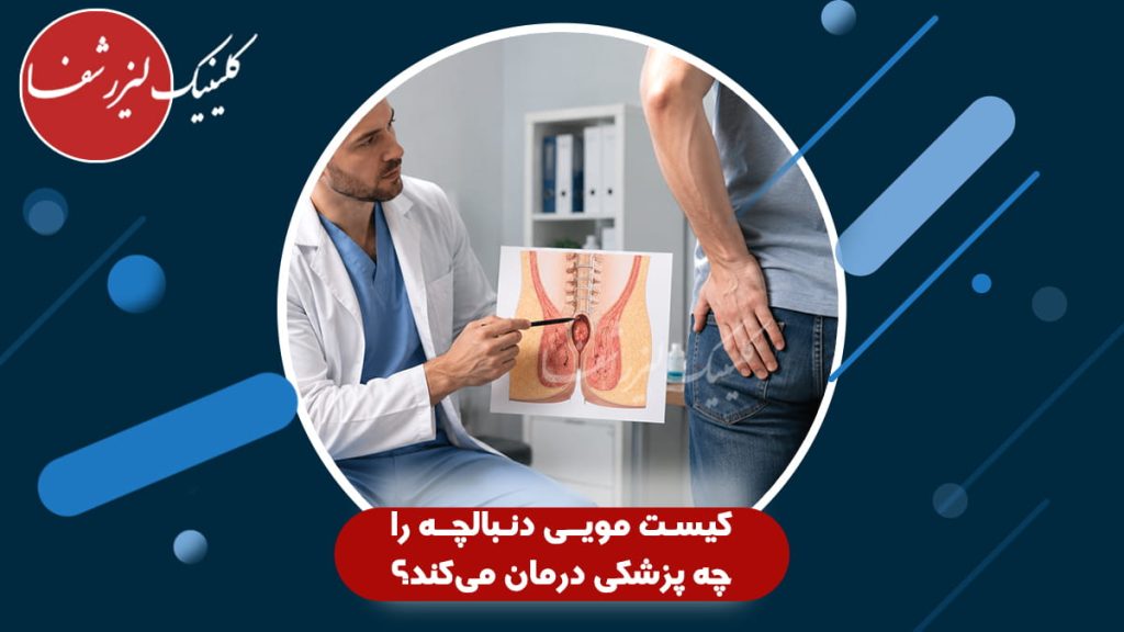 پزشک متخصص در حال بررسی کیست مویی دنبالچه با استفاده از تصویر آناتومی بدن برای بیمار