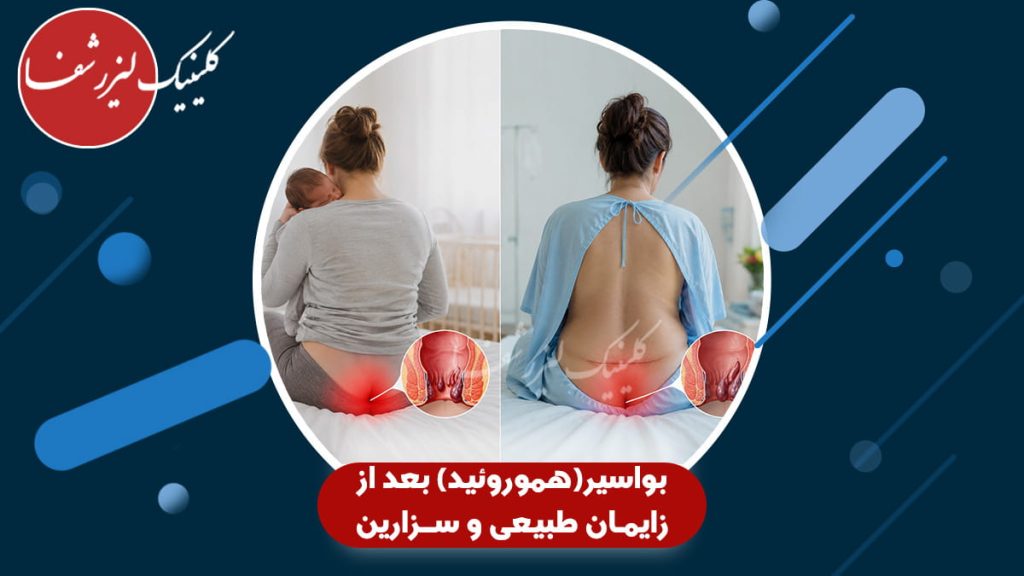 مقایسه بروز بواسیر (هموروئید) بعد از زایمان طبیعی و سزارین در مادران