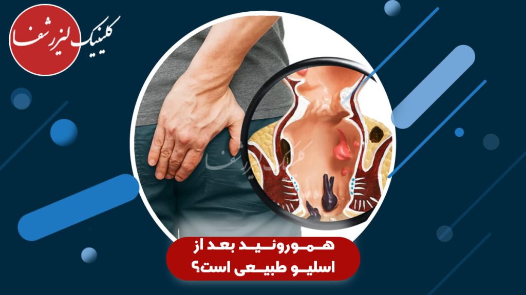 تصویر مفهومی ابتلای به هموروئید بعد از جراحی اسلیو معده و نمایش مقطع مقعدی آن.